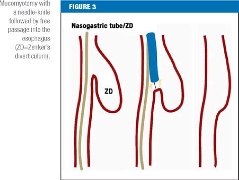 Figure 2 From Therapy Of Zenker S Diverticulum Semantic Scholar