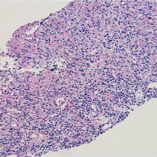 Axillary Lymph Node Biopsy Demonstrating Necrotizing Lymphadenitis H E