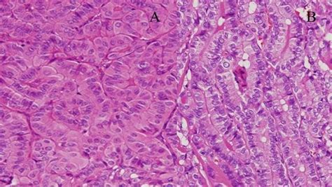 Tall Cell Variant Ptc Oxyphilic Type A And Non Oxyphilic Type B