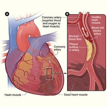 PENYAKIT JANTUNG KORONER, GEJALA DAN PENGOBATANNYA