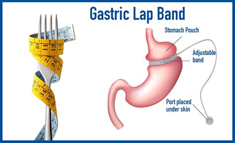 Lap Band Surgery Port