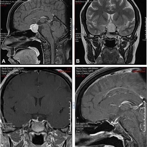 Preoperative And Postoperative Pituitary Magnetic Resonance Imaging