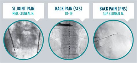 About Implantable Neurostimulator Devices Panhandle Orthopaedics