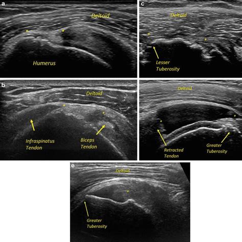 Ultrasound In Rotator Cuff Evaluation Musculoskeletal Key