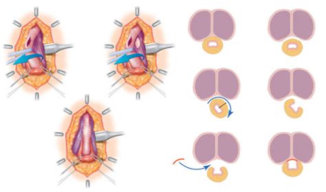 Anterior Urethral Strictures And Retrograde Urethrography An Update For Radiologists Clinical