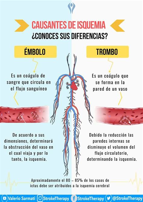 Todo Lo Que Necesitas Saber Sobre La Isquemia Cerebral Cosas De