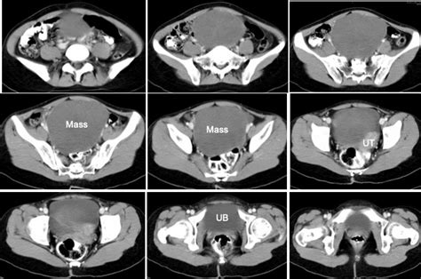 Ovarian Leiomyoma Radiology Cases