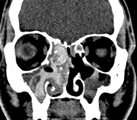 Allergic Fungal Sinusitis Neuro Mr Case Studies Ctisus Ct Scanning