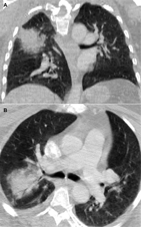 Tomografía computada de tórax en ventana pulmonar que muestran