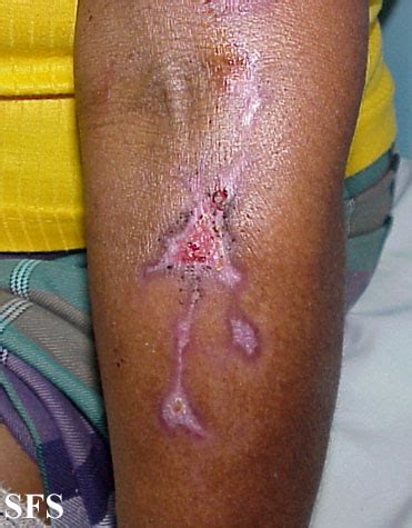 Factitial Dermatitis NC Commons