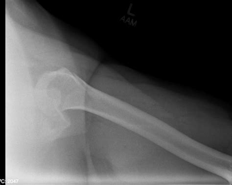 Glenohumeral Dislocation Anterior And Posterior Undergraduate