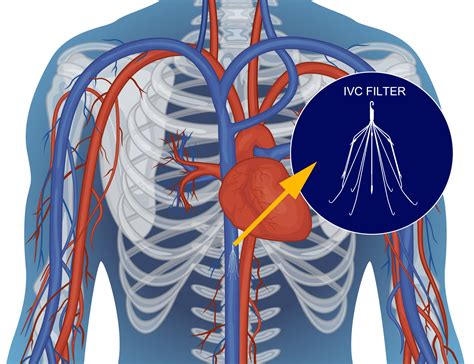 Deep Vein Thrombosis Expert Ir Neuro And Vascular Clinic