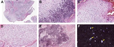 Calcified Chondroid Mesenchymal Neoplasms Surgical Pathology Clinics