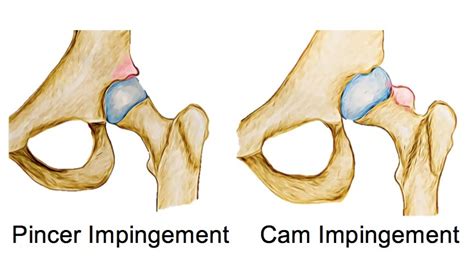 Femoroacetabular Impingement Fai Therapia