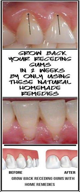 Receding Gums Grow Back In 2 Weeks With Natural Home Remedies