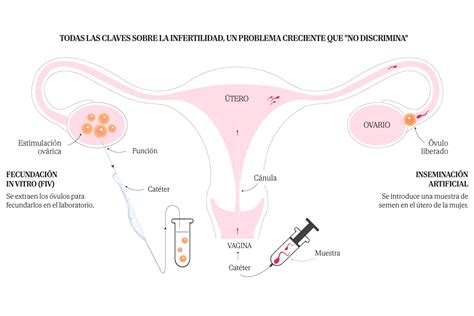 La Infertilidad Masculina Pasa Desapercibida Solo Se Detecta En El