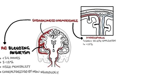 Subarachnoid Haemorrhage / pathophysiology, complications and management - Pacano Medical News