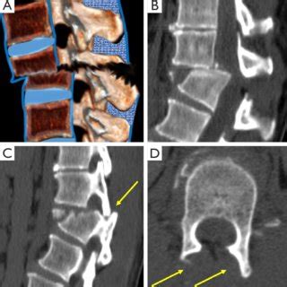 Pdf Classifying Thoracolumbar Fractures Role Of Quantitative Imaging