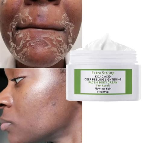 60g ácido kojic extra forte 7 dias clareamento descamação rosto creme