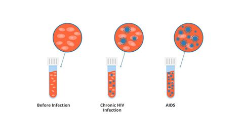 Hiv Vs Aids Priority Std Testing