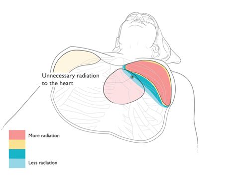 Radiation Therapy Diagram