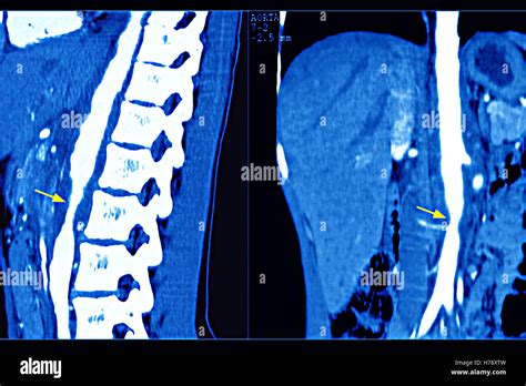 Takayasus Arteritis Stock Photo Alamy