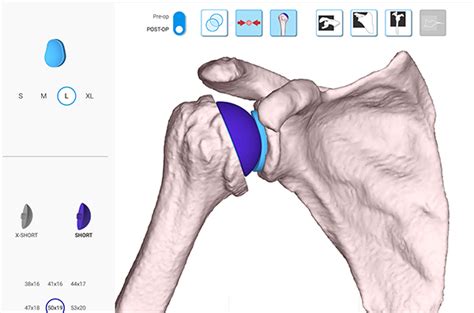 Total Shoulder Replacement Schaumburg Thomas Obermeyer Md