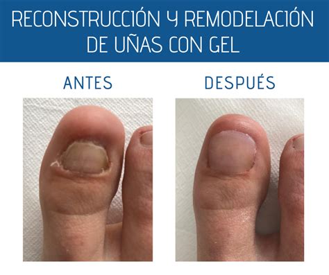 Conoce como reconstruir las uñas del pieCarmen Moral