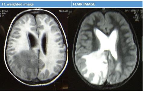 Space Occupying Lesion In The Brain What Is It Pediatric Oncall Journal