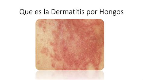 Dermatitis Por Hongos En La Piel Ppt