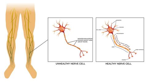 Peripheral Neuropathy Creative Bioarray Cellassay