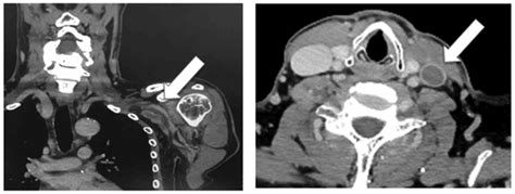 Deep Vein Thrombosis Of The Upper Extremity Caused By Central Venous