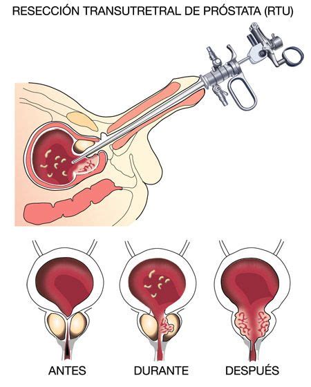 Resecci N Transuretral De Pr Stata Rtu Centro Gil Vernet De Urolog A