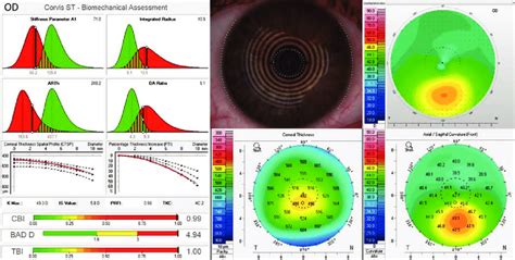 Composite With The Arv Tbi Display Corvis St Pentacam And The