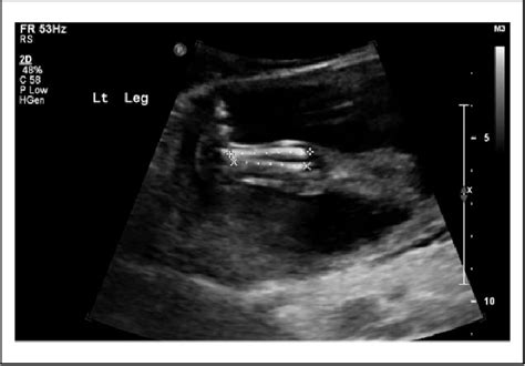 Figure 1 From Prenatal Sonographic Detection Of Skeletal Dysplasias