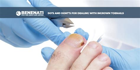 Do’s and Dont's for Dealing with Ingrown Toenails | Benenati Foot and ...