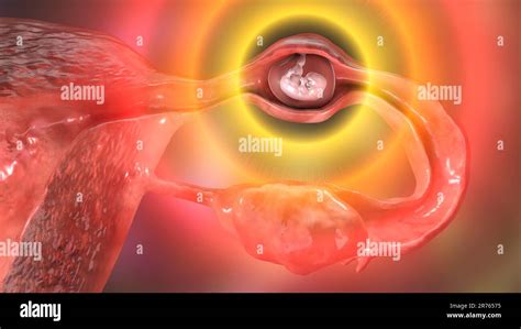 Ectopic Pregnancy Illustration The Embryo Has Implanted In The