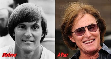 Bruce Jenner Plastic Surgery: From Male Athlete to Female Star