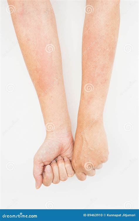 Skin Rashes, Allergies Contact Dermatitis ,allergic To Chemicals Stock Photo - Image of hand ...