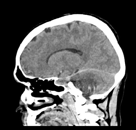 Jugular Foramen Schwannoma Image Radiopaedia Org