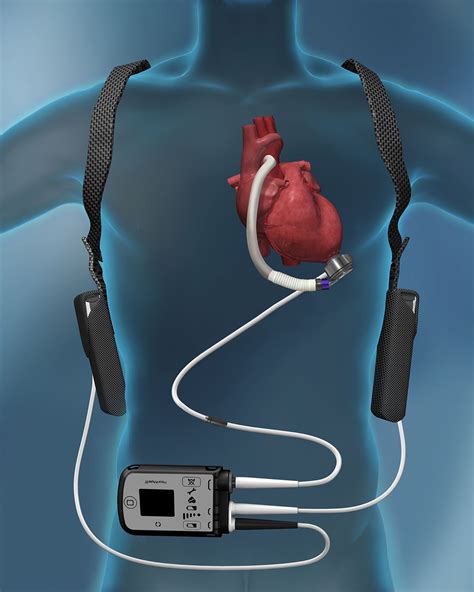 Left Ventricular Assist Device Lvad Kunsthart Steunhart