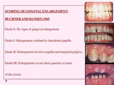 Gingival Enlargement