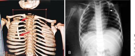 Pdf Recognition Of A Rare Intrathoracic Rib With Computed Tomography