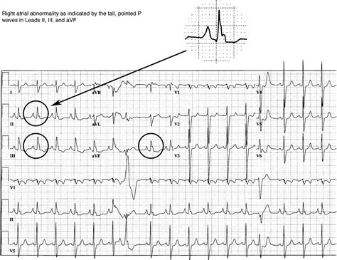 Chamber Abnormalities And Intraventricular Conduction Defects Ecg In