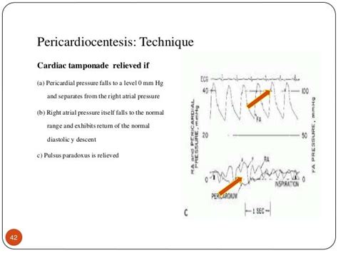 Pericardiocentesis