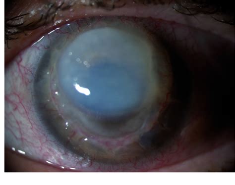 Figure 1 From International Medical Case Reports Journal Dovepress Synergistic Effect Of