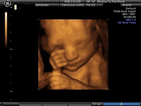 25 Weeks Pregnant Ultrasound