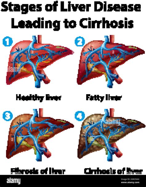Estadios De La Enfermedad Hep Tica Que Conducen A La Cirrosis Imagen