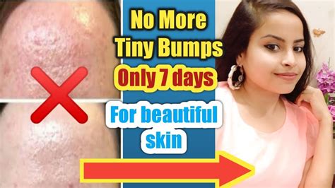 Days Challange L Get Rid Of Tiny Bumps On Face At Home L Treat