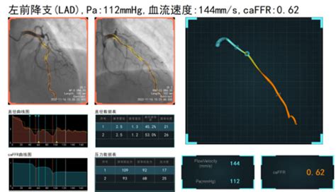 我院心血管内科（一）病区成功开展caffr新技术 皖南医学院第二附属医院